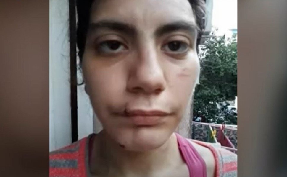 Σημάδια κακοποίησης στο πρόσωπο της 23χρονης/Screenshot