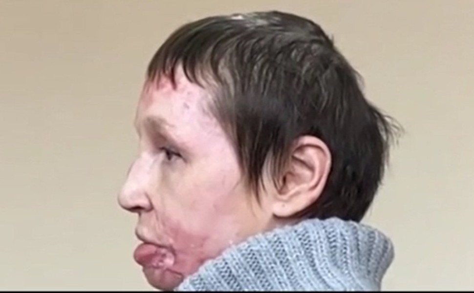 Η Οξάνα, που υπέστη βασανιστήρια από τον σύντροφό της/Ρωσικό τηλεοπτικό δίκτυο